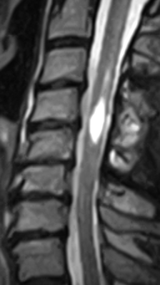 Syringomyelie der Halswirbelsäule auf dem MRT