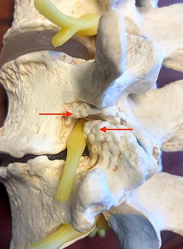 Neuroforaminal stenosis on the model: calcium deposits pressing on the nerves are marked in red (yellow).