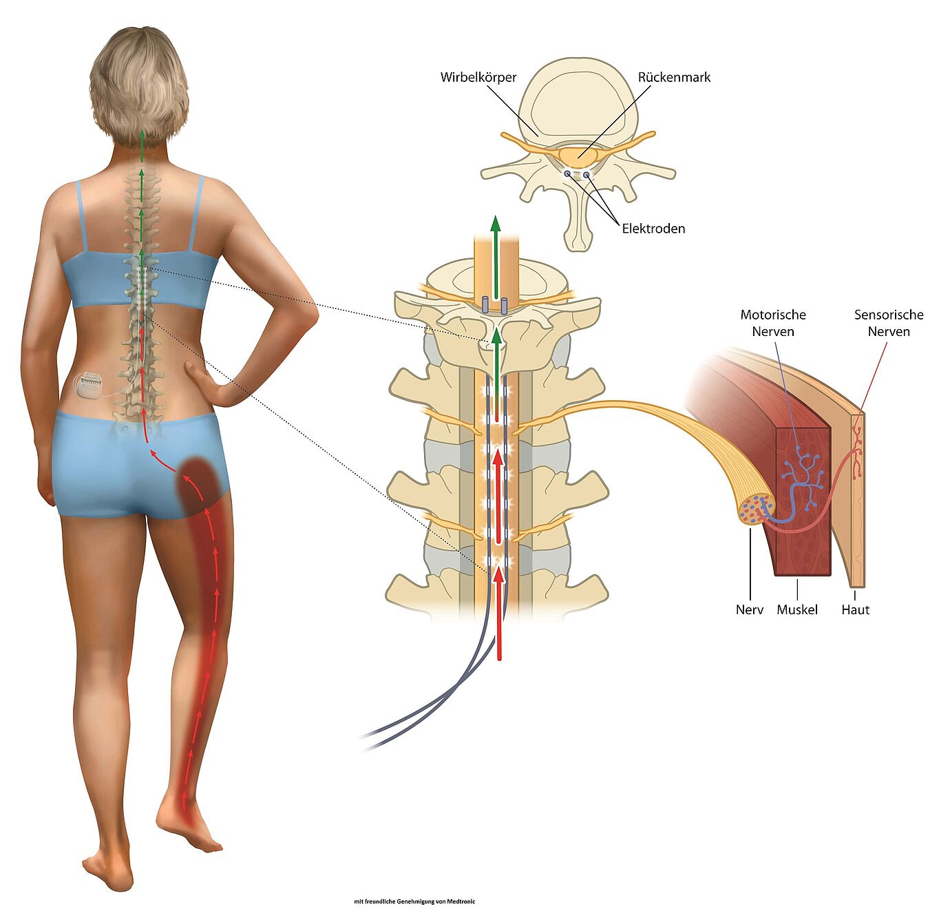 Grafik zur Therapie der Rückenmarkstimulation mit Schmerzschrittmacher