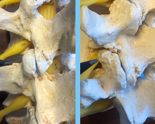 Normales Wirbelgelenk mit glatter Gelenkfläche (links) und deutlich sichtbare Arthrose des Wirbelgelenks (rechts)
