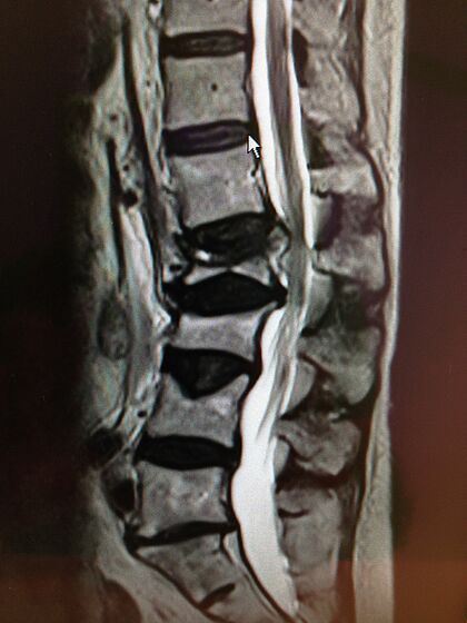 Fracture of the lumbar spine