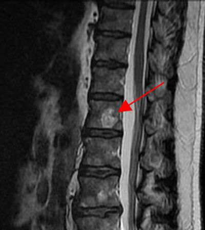 Hemangiomas of the spine