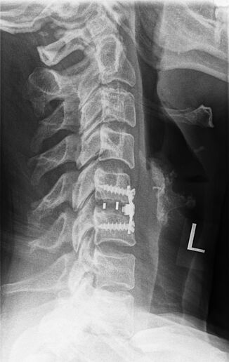  X-ray after successful spondylodesis