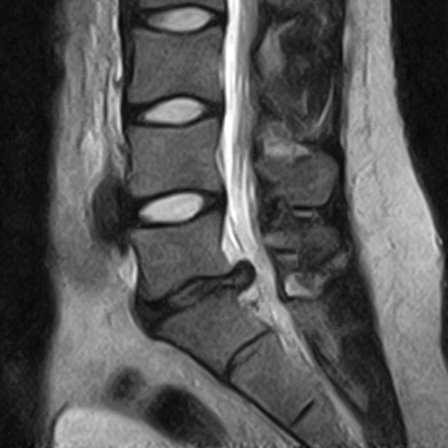 Herniated disc lumbar spine L5/S1