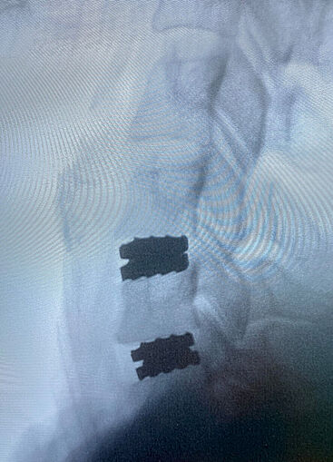 Artificial intervertebral disc in X-ray
