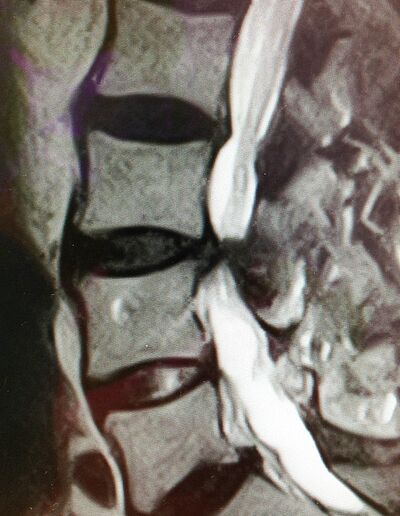 MRI of spinal canal stenosis