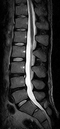 Röntgenbild av en ryggrad med degenerativa skador