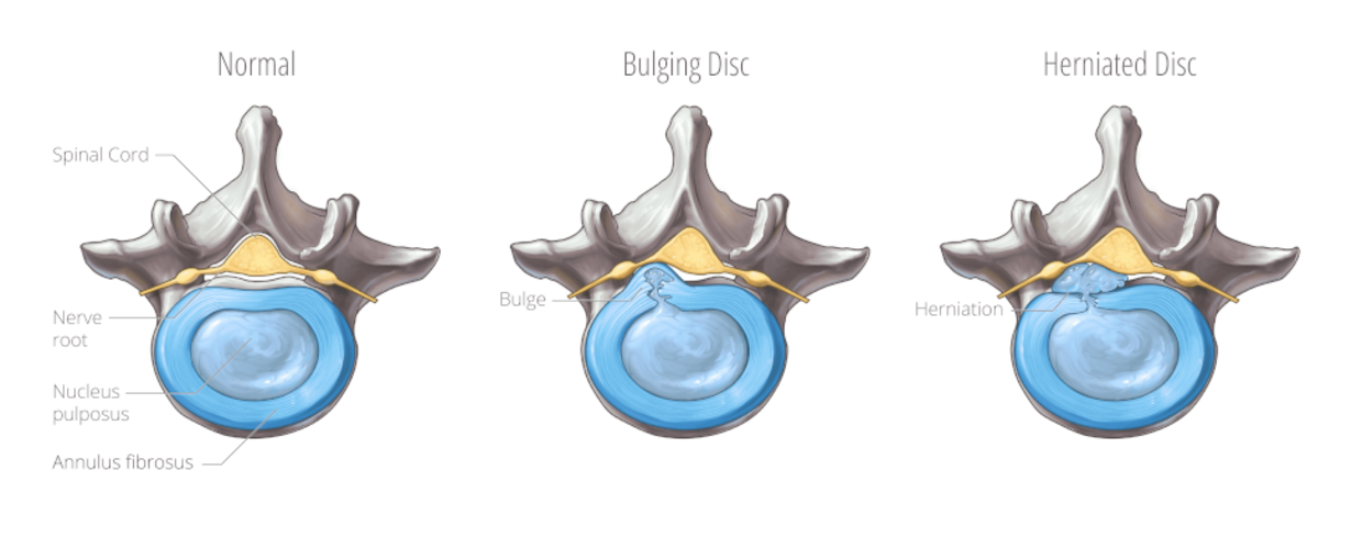 Comparison between healthy disc and herniated disc