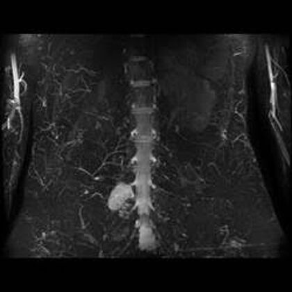  X-Ray with a Spinal tumor