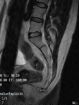 X-ray of a tailbone