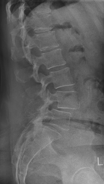 X-Ray image of a spondylolisthesis