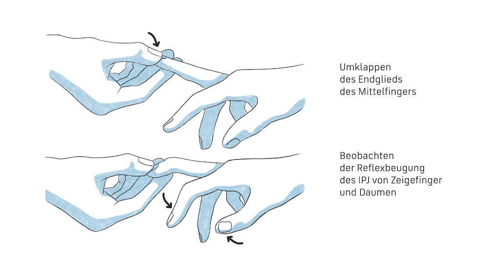 Darstellung des Hoffmann Reflex