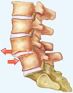 Anatomical representation of the vertebral slippage