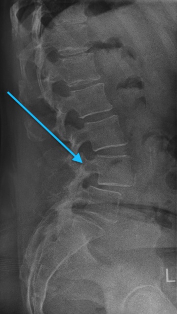 Wirbelgleiten / Spondylolisthese auf einem Röntgenbild