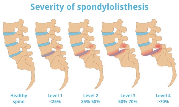 Presentation of the severity of spondylolisthesis