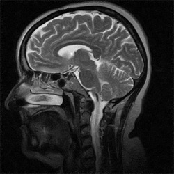 Das menschliche Gehirn auf einer MRT Aufnahme