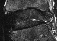  Image of an intervertebral disc with wear