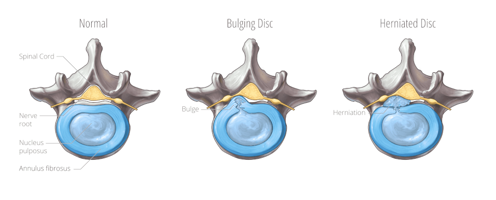 Illustration of the difference between a bulging disc, disc herniation and a normal disc