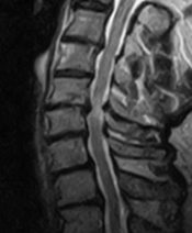 Herniated disc cervical spine with myelopathy