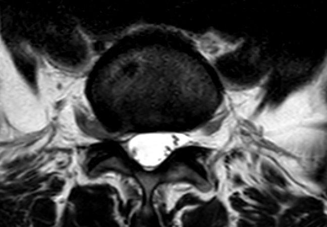 X-Ray of an extraforaminal disc herniation