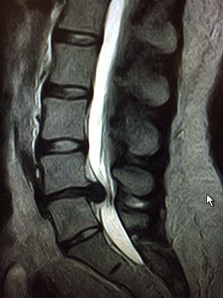 MRI image of a herniated disc of the lumbar spine (LS)