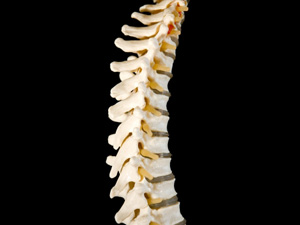 Representación de una columna vertebral inestable