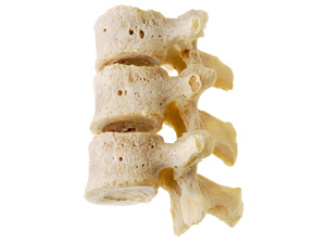 Darstellung von menschlichen Wirbeln mit Osteoporose
