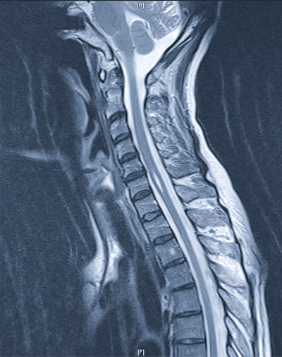 Syringomelia on an MRI image