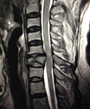 X-ray of a vertebral fracture