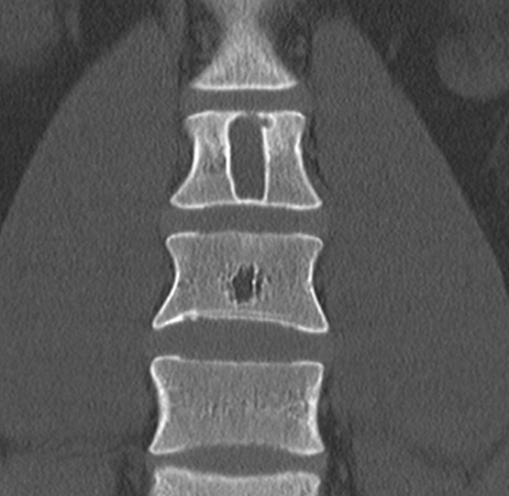 Eine deutlich erkennbare Knochenzyste auf einem Röntgenbild