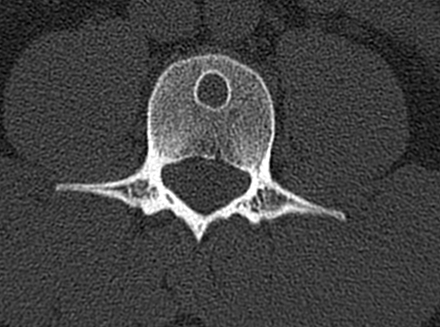 Ein Röntgenbild, das eine Knochenzyste zeigt