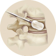 The vertebrae are widened during a kyphoplasty