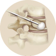 The balloon in the vertebra is reduced in size during a kyphoplasty