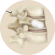 Bone cement is released into the vertebra in the final step of a kyphoplasty