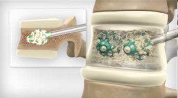 Cement is injected into the vertebra through a cannula during a kyphoplasty procedure
