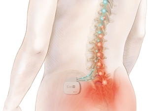 Illustrasjon av en smertepacemaker i kroppen